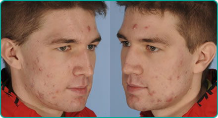 Ben Wade - Before Acne Laser Treatment
